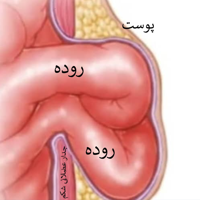 فتق یا هرنی