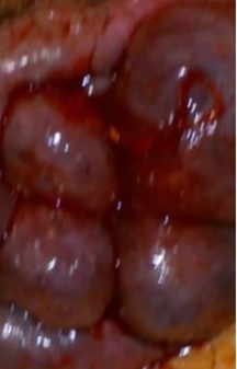 thrombosed hemorrhoid