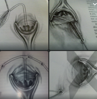 فیستول مخرج Anal Fistula