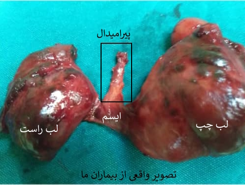 گواتر