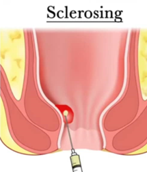 Sclerotherapy