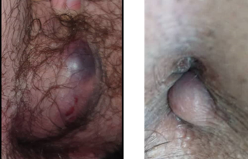 thrombosed hemorrhoid